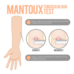 Mantoux Tuberculin Skin Test for Tuberculosis Exposure using Purified Protein Derivative or PPD © Chris
