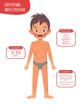 Boy with Erythema Infectiosum Parvovirus B19 Rash Viral Exanthem Series