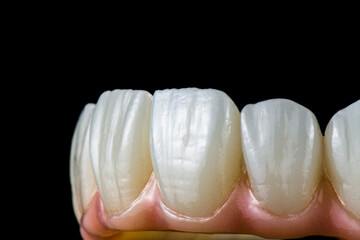 max natural look crowns on implants