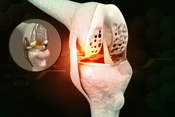 Human knee anatomy with knee replacement. 3d illustration.