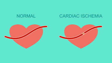 cardiac ischemia flat vector stock illustration