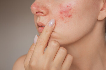 close-up photo of a young Caucasian woman suffering from the skin chronic disease rosacea on her face in the acute stage. Pink acne. Dermatological problems.  isolated on a beige background - obrazy, fototapety, plakaty