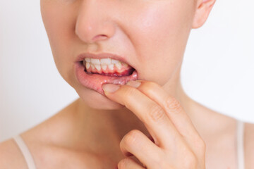 close-up photo of young woman who suffers from inflammation of the gums on the lower jaw. Isolated...