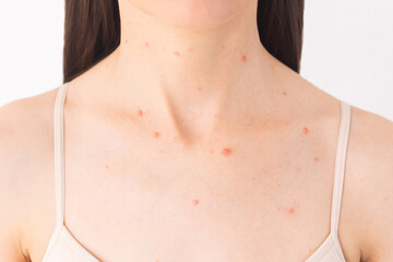 close-up photo of a young dark-haired woman with acne in the chest and neck. Skin diseases....