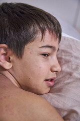 Obraz premium Skin itching, dermatitis, food allergy on the face. A boy with red spots. The child has itching, on the face with an allergic rash.