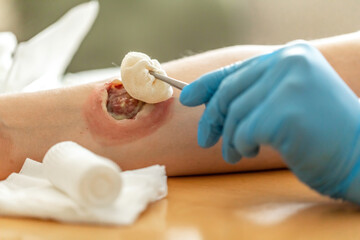 Wound care concept: Symbolizing change of dressing and cleaning and debridement of a wound with a...