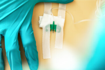 Infusion management: Close-up of a butterfly cannula