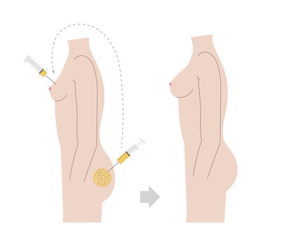 Natural breast augmentation with fat transferred into the breast from other body parts. Fat tissue injection illustration with before and after effect on naked body side view..