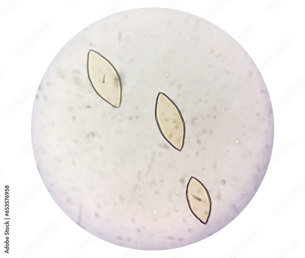 Poster Photomicrograph of Uric acid crystal in urine sediment