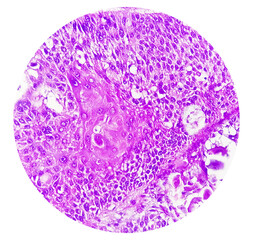 Photomicrograph of Invasive squamous cell carcinoma of the nipple, Grade-II