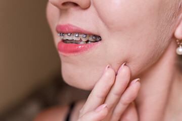 Close-up of a young woman smiling with braces on her teeth