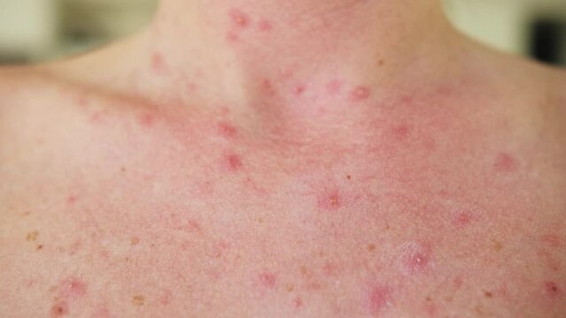 Close-up of chicken pox on the breast of an adult person.