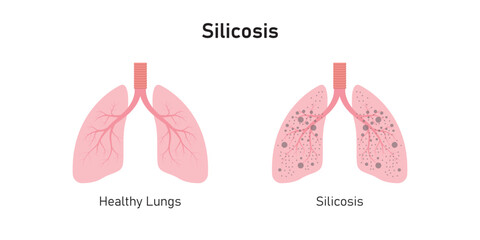 Silicosis Pulmonary Fibrosis Concept Design. Vector Illustration.