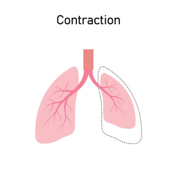 Contraction Atelectasis Concept Design. Vector Illustration.