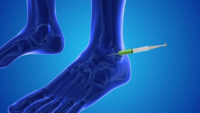 Injecting stem cells into a human feet
