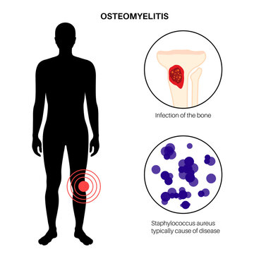 Tibia bone osteomyelitis