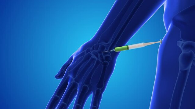 Injecting stem cells into a human wrist.