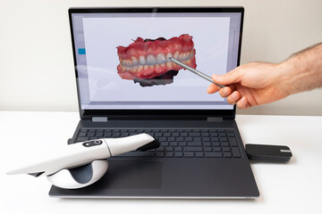 Dentist Shows 3D Scanned Picture of Scanned Teeth on Monitor of Computer. White 3d Intraoral Dental...