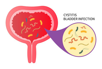 urinary tract infection with the E coli and C diff fungal germ cause frequent urge urination or Bloody urine pelvic painful