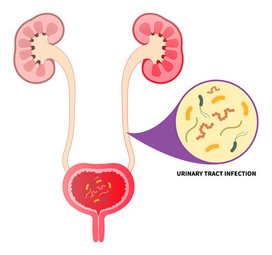 Bacteria infection of urinary tract with the E coli and C diff fungal germ cause frequent urge urination or Bloody urine pelvic painful