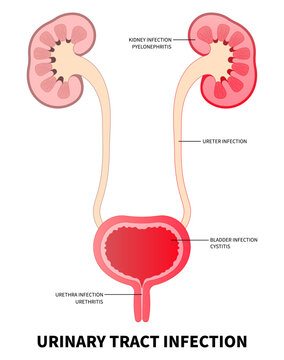 The kidney ureter bladder inflammation of urinary tract infection with the E coli and C diff fungal germ cause frequent urge urination or Bloody urine pelvic painful in medical