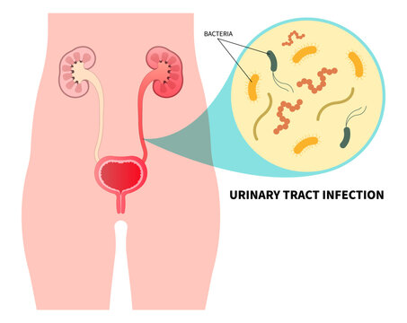 Kidney stone that lead to bacteria infection of urinary tract with the E coli and C diff fungal germ cause frequent urge urination or Bloody urine pelvic painful