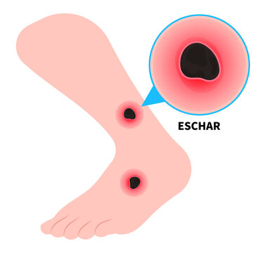 Foot leg wounds and skin infection with eschar or scrub typhus the bacteremia hand sepsis in diabetes patient