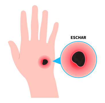 Wounds on hand and skin infection with eschar or scrub typhus the bacteremia sepsis in diabetes patient