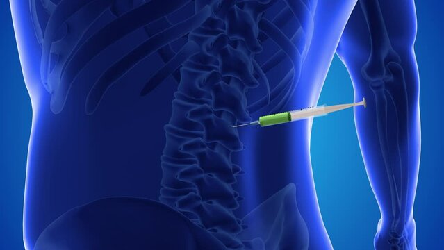 An animation shows stem cells being injected into a spine