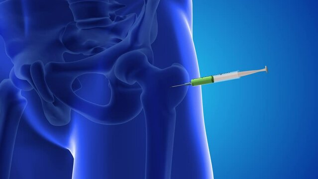 An animation shows stem cells being injected into a thighs