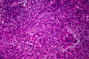 Fibrosarcoma, light micrograph