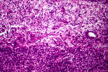 Fibrosarcoma, light micrograph