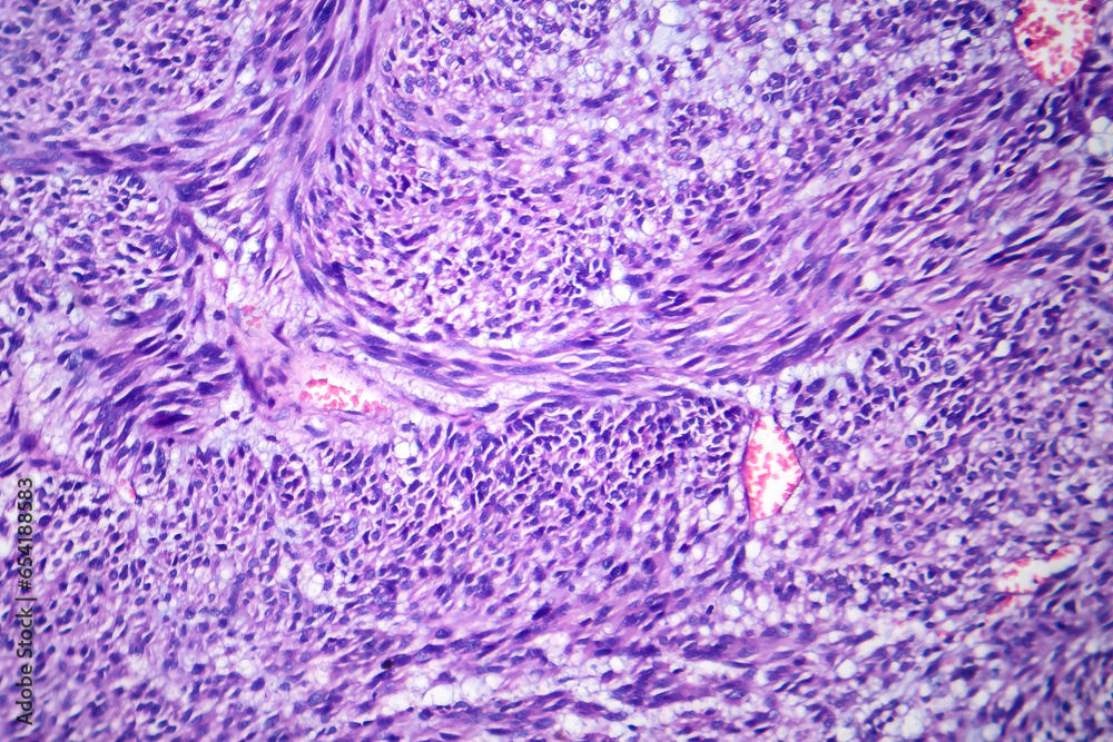 Poster leiomyoma, light micrograph