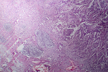 Mucinous carcinoma in the stomach, light micrograph