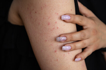 Red rash on the shoulder. Strawberry skin, long pastel pink nail design. Hand skin with atopic keratosis dermatology problem. 
