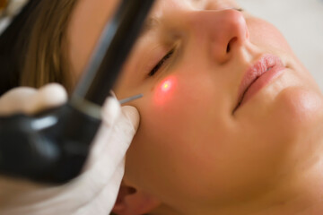 Close up of a woman receiving a laser treatment on her face
