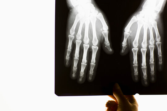 Hand of healthcare professional holding x-ray of a pair hands
