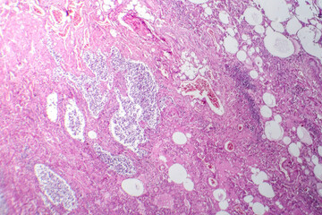 Small cell lung cancer, light micrograph