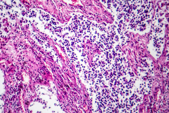 Small cell lung cancer, light micrograph