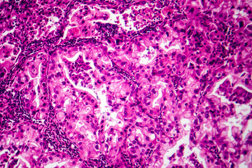 Lung cancer tissue, light micrograph