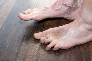 Man's deformed hammertoes showing left foot one year after surgery showing multiple conditions...
