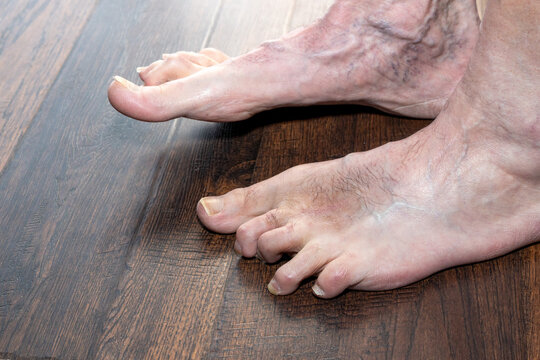 Man's deformed hammertoes showing left foot one year after surgery showing multiple conditions including toenail fungus and phlebitis.