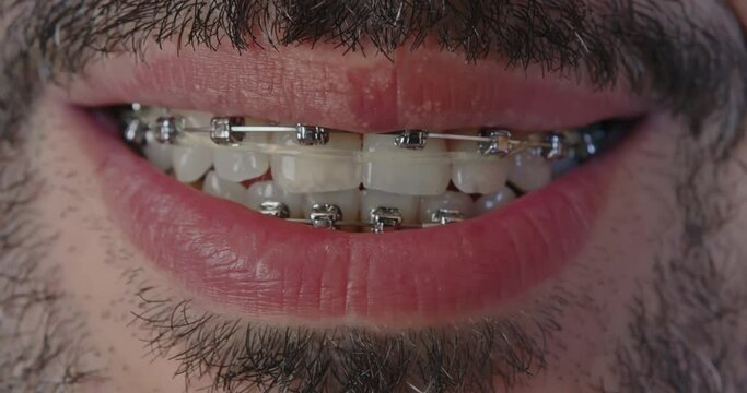 Close-up of a metal bracket system on white, even teeth. Braces for bearded man