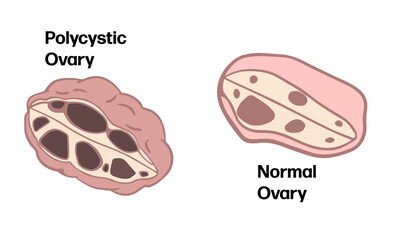 Polycystic Ovary Syndrome themed background
