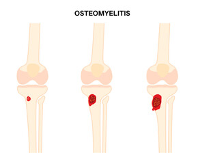Tibia bone osteomyelitis