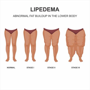 Lipedema stages and symptoms illustration