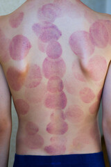 Traces from cupping massage on a child's body. Alternative medicine. Healing. Improving blood...