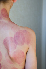 Traces from cupping massage on a child's body. Alternative medicine. Healing. Improving blood...