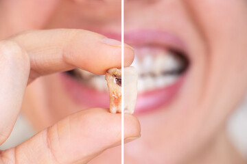 A girl in her hand holds an extracted tooth divided into two parts, one half of the tooth with a...
