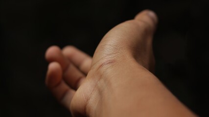 Scar on the hand area with black background